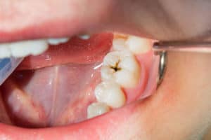 dental caries