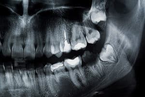 Impacted Wisdom Tooth